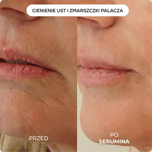 Serumina Mikroinfuzji 1.0