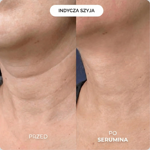 Serumina Mikroinfuzji 1.0