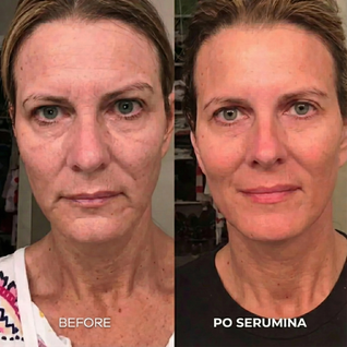 Serumina Mikroinfuzji 1.0